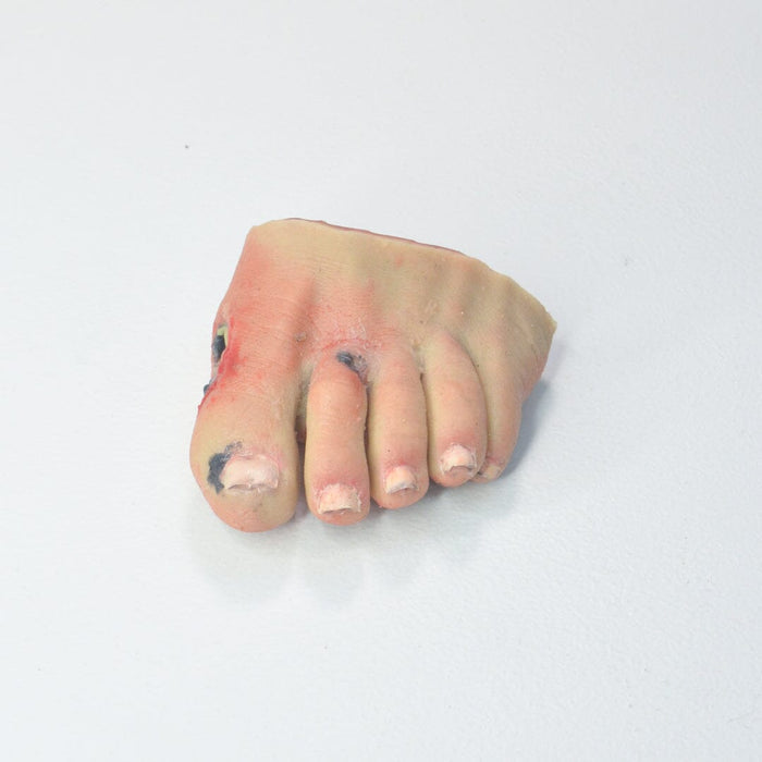 Frostbitten Foot